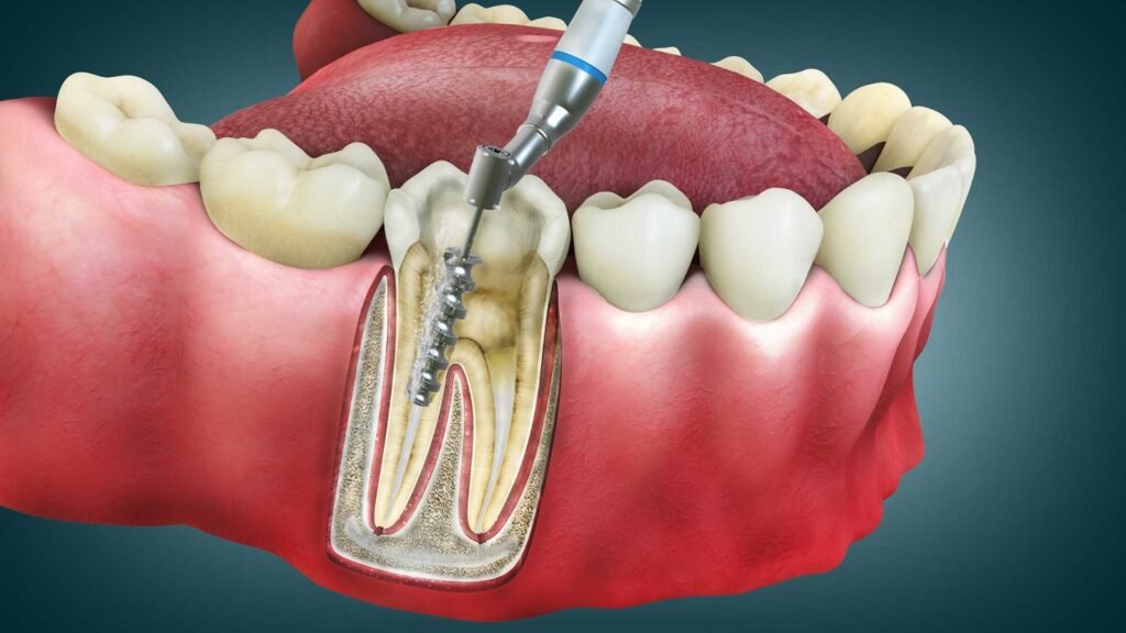 Affordable Endodontics Services Miyapur