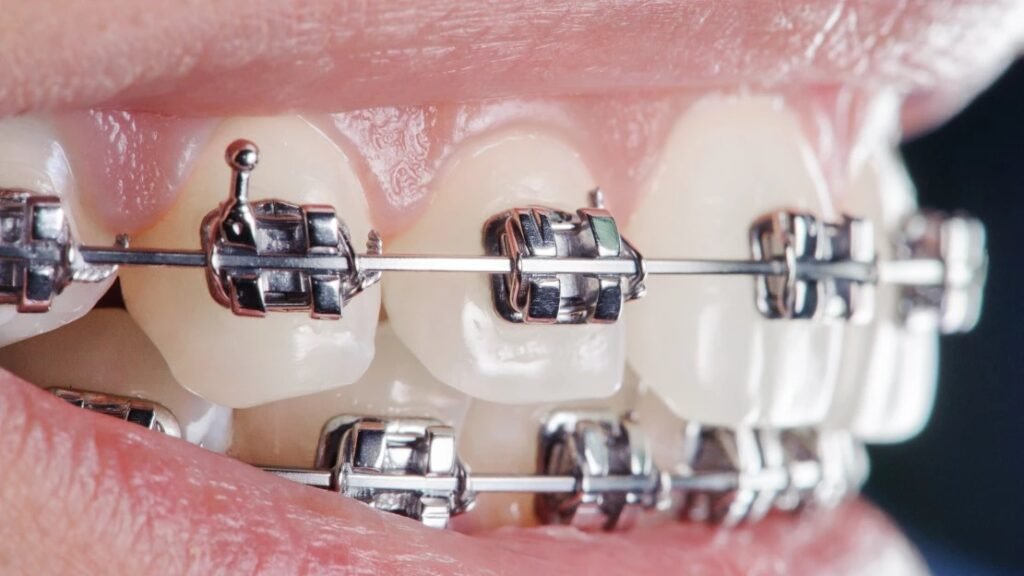 Affordable Orthodontics and Braces Treatment in Miyapur
