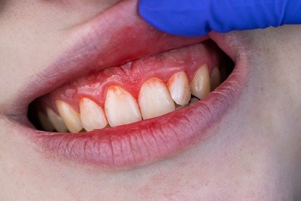 Periodontics Treatment in Miyapur